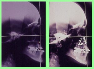 Cirugía ortognática doble y ortodoncia Cirugía ortognática doble y ortodoncia