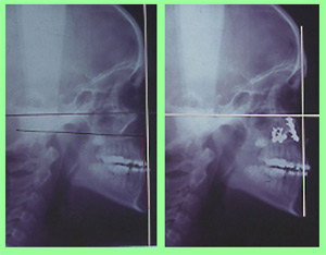 Cirugía ortognática simple y ortodoncia en un labio leporino Cirugía ortognática simple y ortodoncia en un labio leporino