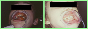 Cirugía ortognática simple y ortodoncia en un labio leporino Cirugía ortognática simple y ortodoncia en un labio leporino