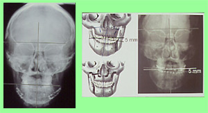 Cirugía ortognática doble y ortodoncia en una asimetría facial Cirugía ortognática doble y ortodoncia en una asimetría facial