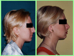 Blefaroplastia: Cirugía plástica de los párpados Blefaroplastia: Cirugía plástica de los párpados