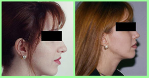Infiltración de labios, aumento de labios Infiltración de labios, aumento de labios