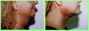Liposucción del cuello.