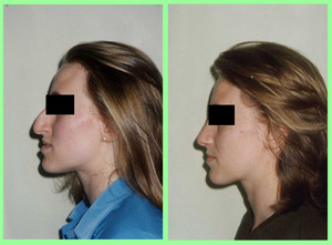 Rinoplastia: Nariz aguileña