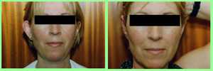 Otoplastia: Orejas de soplillo Otoplastia: Orejas de soplillo