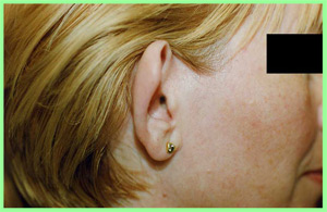 Otoplastia: Orejas de soplillo Otoplastia: Orejas de soplillo