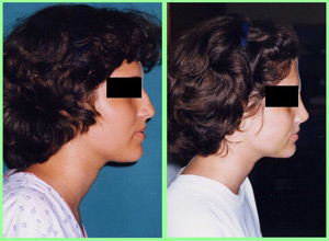 Rinoplastia: Dorso aguileño